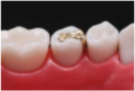 金歯（ゴールドインレー）