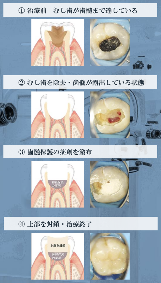 歯髄保存療法の治療工程の写真