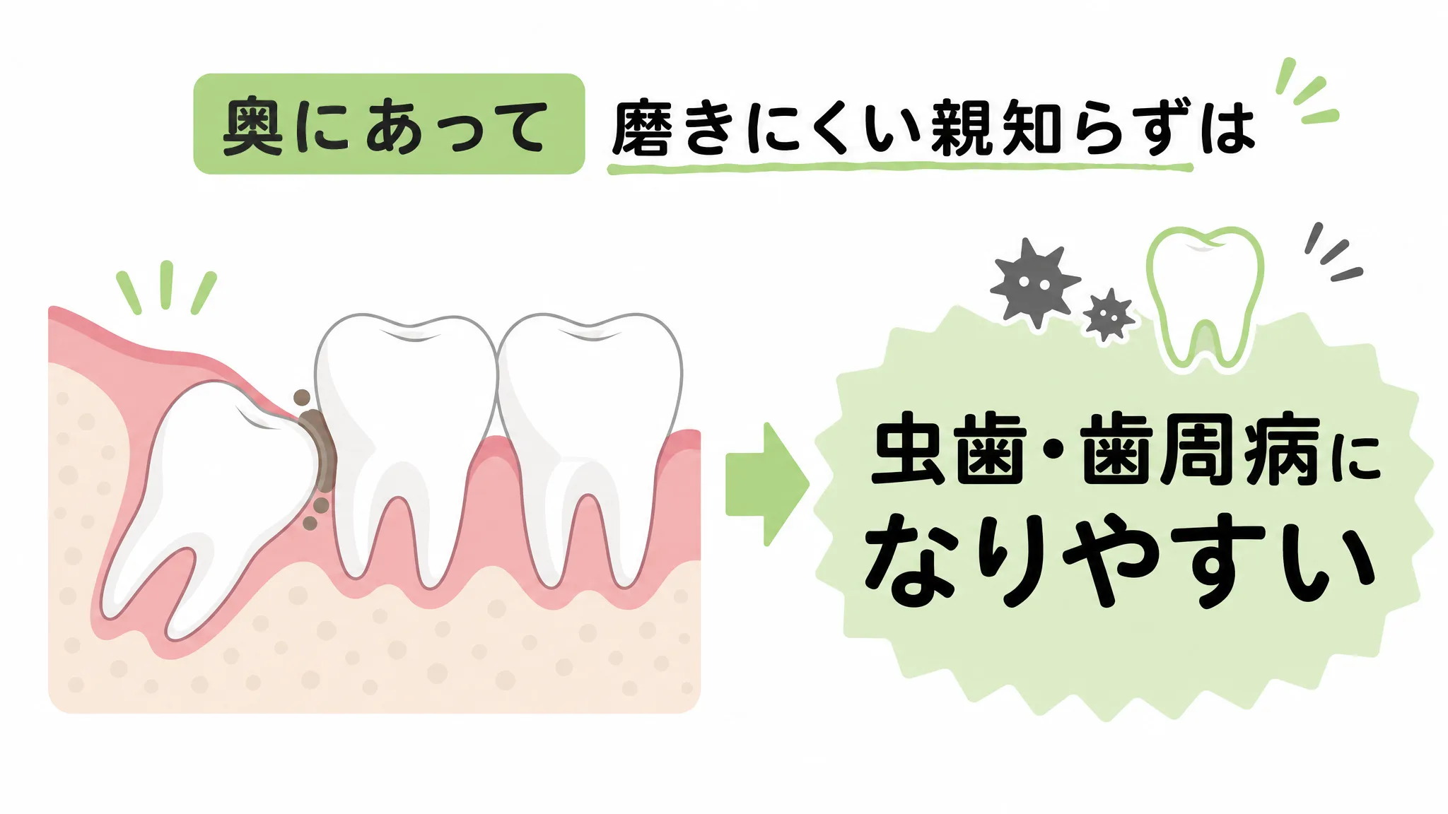 親知らずは奥にあって磨きにくいため、虫歯や歯周病になりやすい